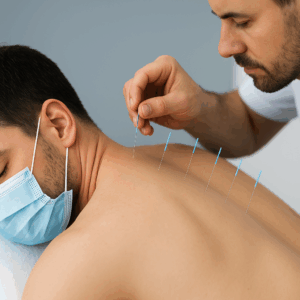 Dry needling Therapy